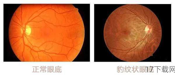 豹纹状眼底,这一听起来就让人心生畏惧的名词,其实是高度近视的典型眼底病变之一,由于近视度数过高,眼轴被拉长,视网膜因此变得薄弱,血管变得清晰可见,从而呈现出类似豹皮纹理的眼底改变,这种病变不仅影响视力,还可能引发一系列严重的眼底疾病,如视网膜脱落、黄斑变性等。