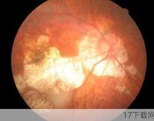 豹纹状病变除了高度近视外,还可能由年龄增大、视网膜病变、视网膜脱离、黄斑变性等多种因素引起,随着年龄的增长,眼睛会发生退行性病变;而视网膜病变、视网膜脱离等则可能直接影响视网膜的正常结构和功能;黄斑变性则与遗传因素和炎症损伤有关,在出现豹纹状病变时,应及时就医检查,明确病因并采取相应的治疗措施。