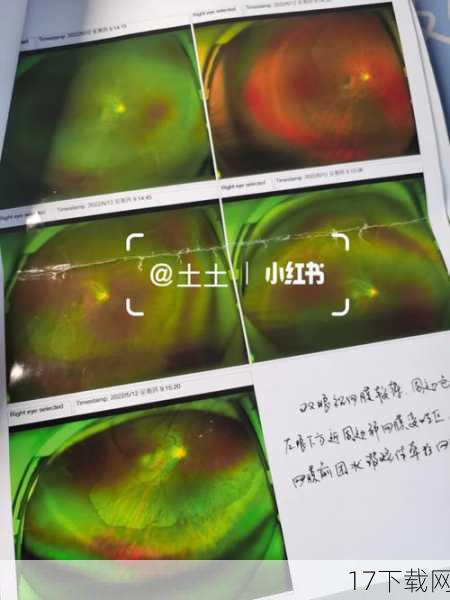 问题二:如何预防高度近视及其引发的豹纹状病变?